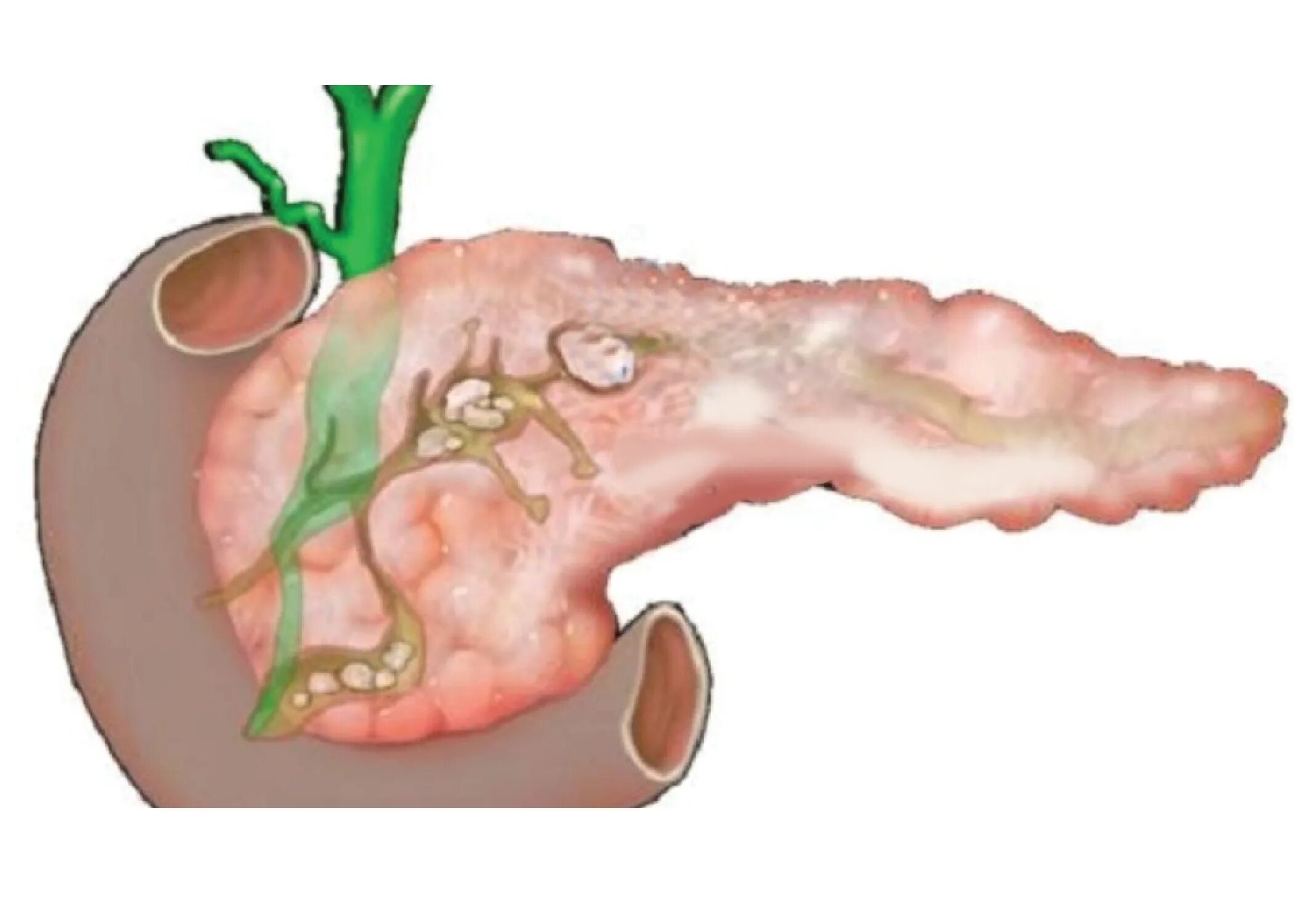 Камни поджелудочной железы. Конкременты панкреатического протока. Панкреатит камни в поджелудочной. Обтурации протоков поджелудочной. Вода в поджелудочной железе