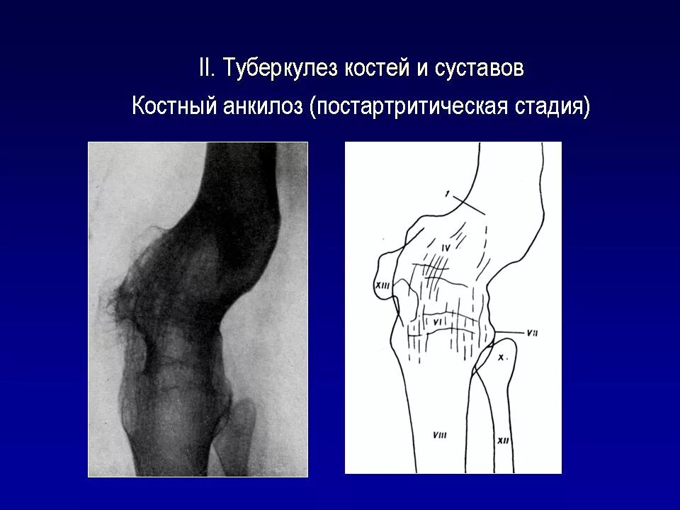 Коленный туберкулез