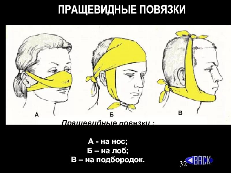 Техника наложения пращевидной повязки. Пращевидная повязка. Наложение пращевидной повязки. Перевязка прощевидная. Места наложения пращевидной повязки.