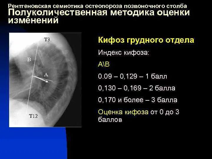 Кифоз грудного отдела степени. Кифоз грудного отдела степени