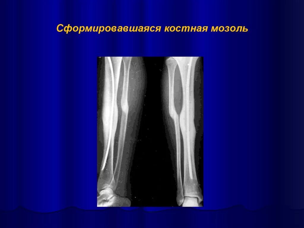 Формирование мозоли при переломе