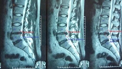 Грыжа позвоночника без операции. Позвоночная грыжа операция. Операция на грыжу позвоночника поясничного отдела. Шрамы после операции на грыжу позвоночника. Лечение позвоночной грыжи операция