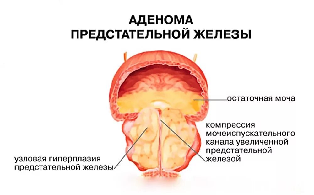Доброкачественная гиперплазия (аденома) предстательной железы. Предстательная железа аденома простаты. Аденома простаты железы. Аденома предстательной железы симптомы. Вылечить предстательную железу