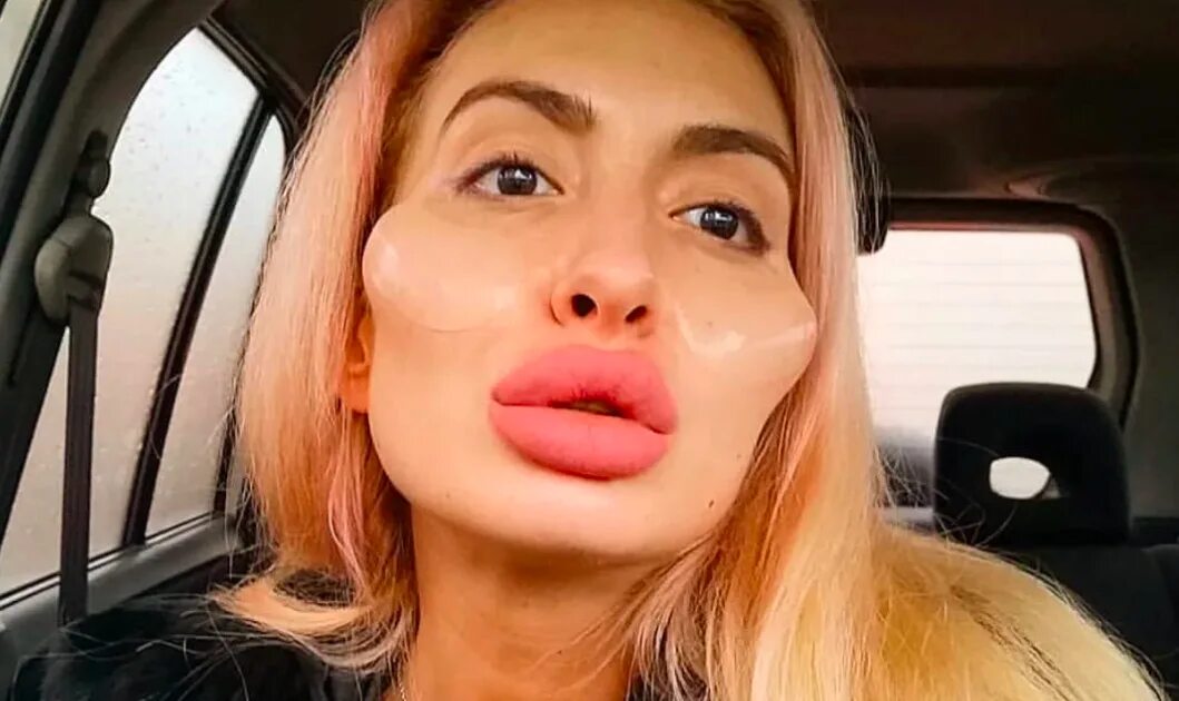 Губы накаченные ботоксом