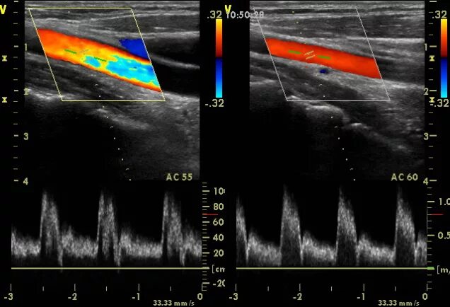 Узи артерий мозга. Допплеровское ультразвуковое исследование сосудов. Допплеровское исследование сосудов мозга. Допплеровское ультразвук исследование сосудов и артерий. Ультразвуковая допплерография сосудов шеи.