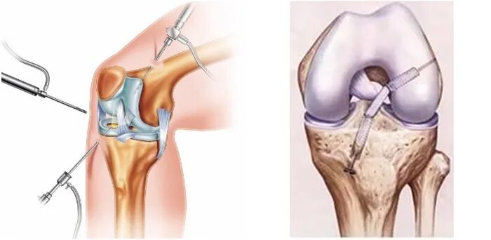 Операция пластика ПКС коленного сустава. Разрыв связок коленного сустава ПКС операция. ПКС (передняя крестообразная связка). Передняя крестообразная связка после операции