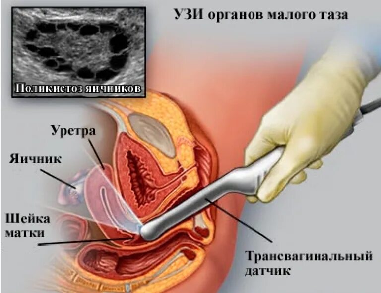 Узи органов малого таза трансвагинально