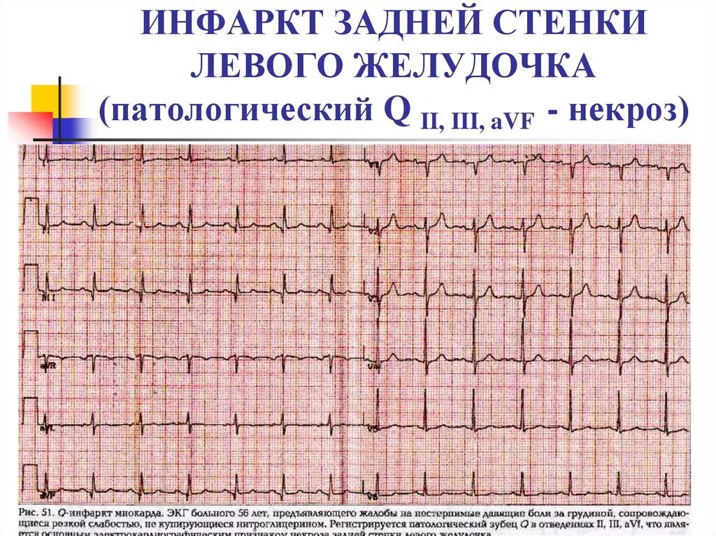 Острый инфаркт миокарда задней стенки на ЭКГ. ЭКГ при инфаркте миокарда задней стенки. ЭКГ при инфаркте передней и задней стенки. Стенки инфаркта миокарда на ЭКГ.