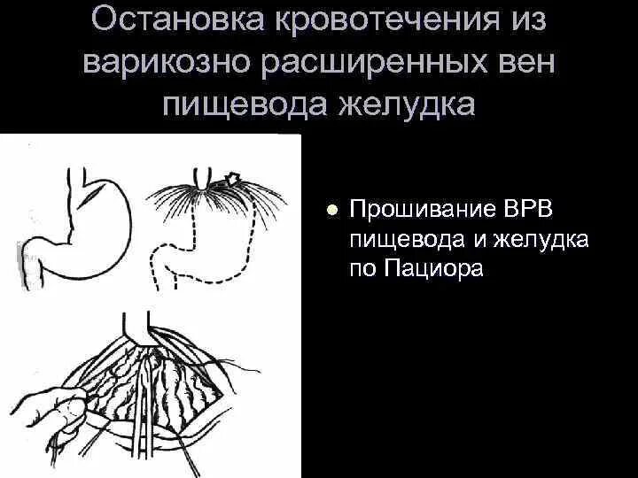 Остановка кровотечения из расширенных вен пищевода. Варикозное расширение вен пищевода патанатомия. Кровотечение из варикозно расширенных вен. Остановка кровотечения варикозно расширенных вен пищевода. Кровотечение из расширенных вен пищевода.