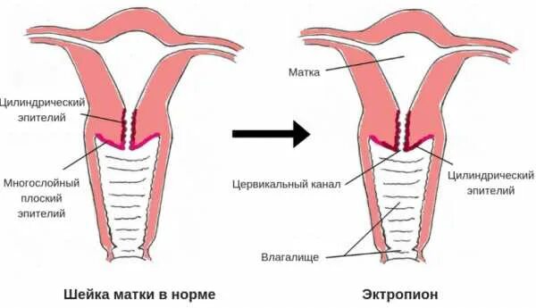Коническая форма шейки. Коническая форма шейки. Шейка матки зона трансформации. Воспаление шейки матки цервицит. Шейка матки цилиндрической формы.