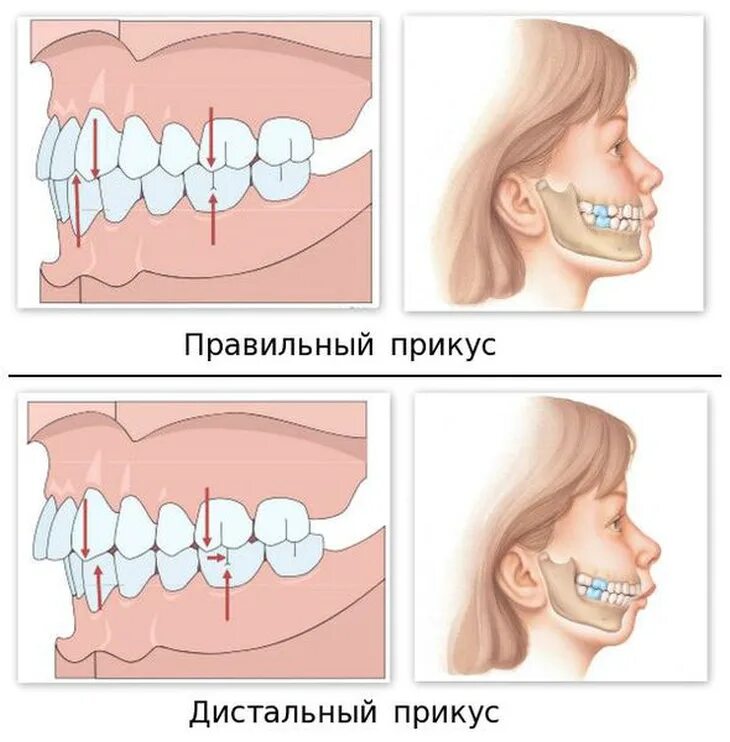 Почему зубы отличаются между собой у разных. Дистальный (прогнатический) прикус. Дистальный и мезиальный прикус. Дистальный прикус прогнатия.