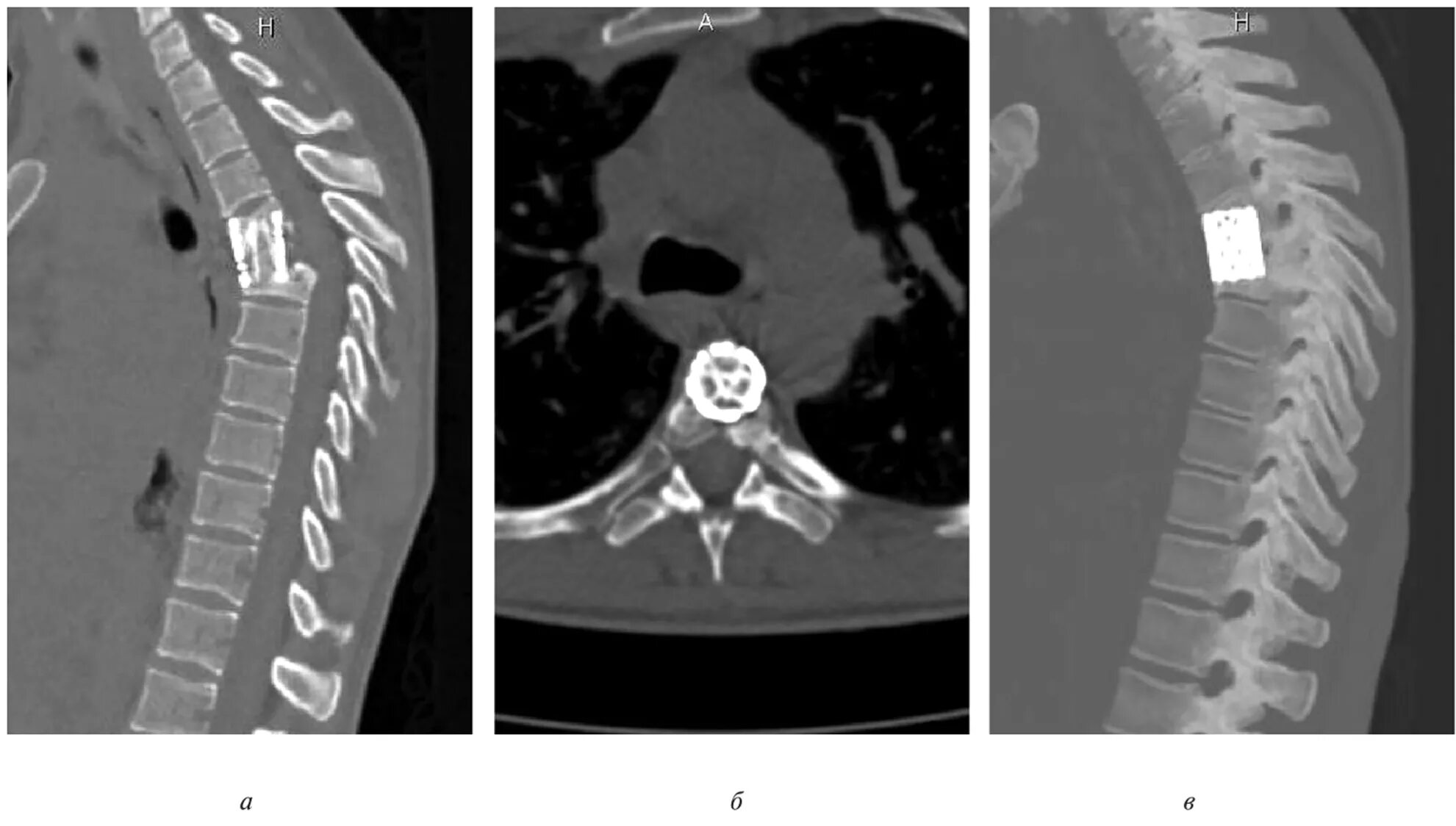Компрессионный перелом позвонка мрт. Компрессионный перелом позвоночника кт. Компрессионный перелом поясничного позвонка мрт. Компрессионный перелом позвоночника в грудном отделе 12. Компрессионная операция на позвоночнике