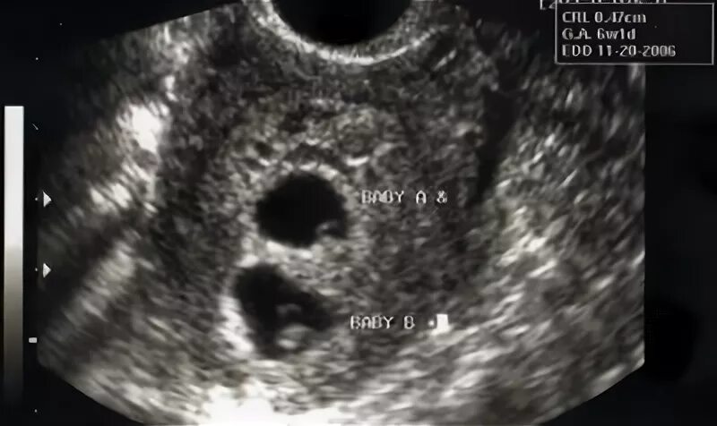 9 неделя даты. УЗИ 6 недель беременности двойня. УЗИ двойни на 5 неделе беременности фото. УЗИ 9 недель беременности двойня. 5-6 Недель беременности близнецов УЗИ.