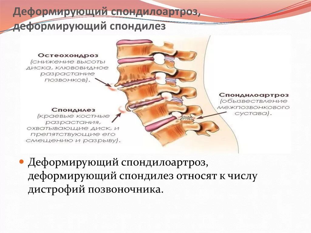 вправление поясничного отдела позвоночника. спондилоартроз пояснично-крестцового отдела позвоночника l1-s1. болезнь бехтерева-анкилозирующий. деформирующий спондилез поясничного отдела l1 s1. деформирующий спондилез спондилоартроз поясничного отдела.