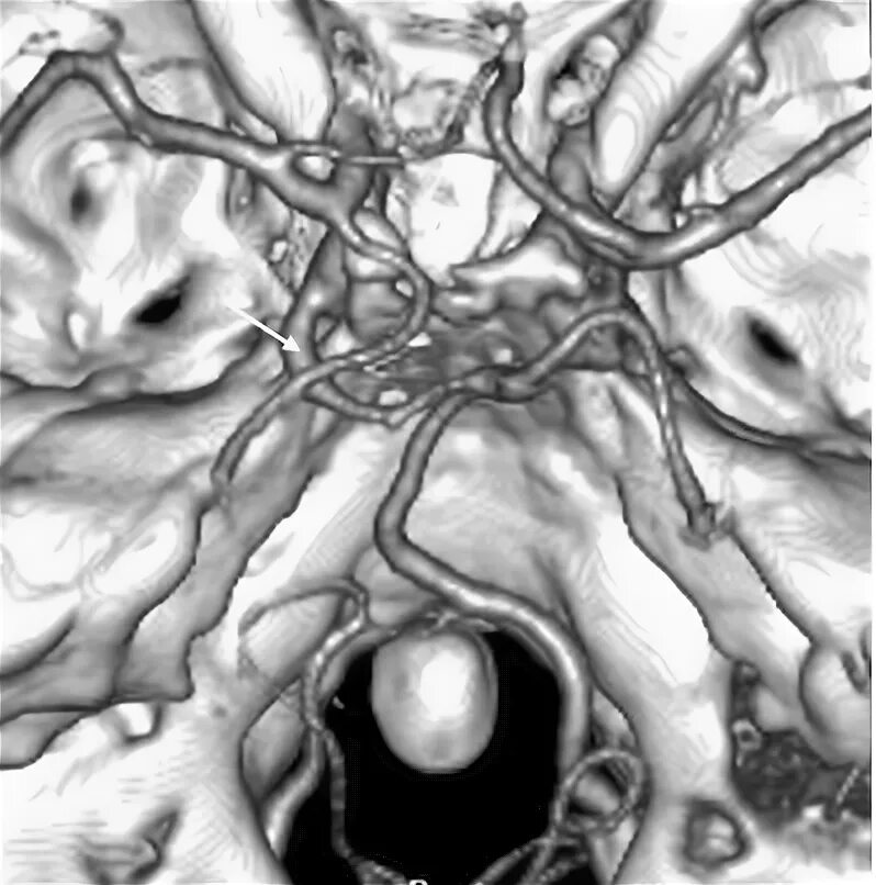 Сосудистая аномалия. Аномалии развития сосудов головного мозга. Трифуркация артерий головного мозга. Фенестрация артерии головного мозга.