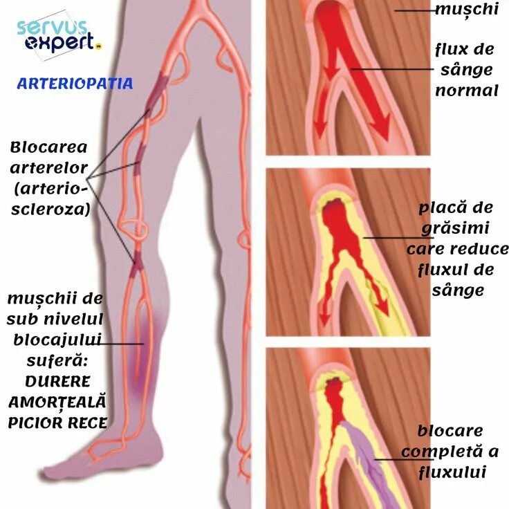 Ишемия нижних конечностей лечение. Облитерирующий атеросклероз сосудов конечностей. Облитерирующий атеросклероз артерий нижних конечностей. Атеросклероз синдром Лериша. Облитерирующий атеросклероз периферических артерий.