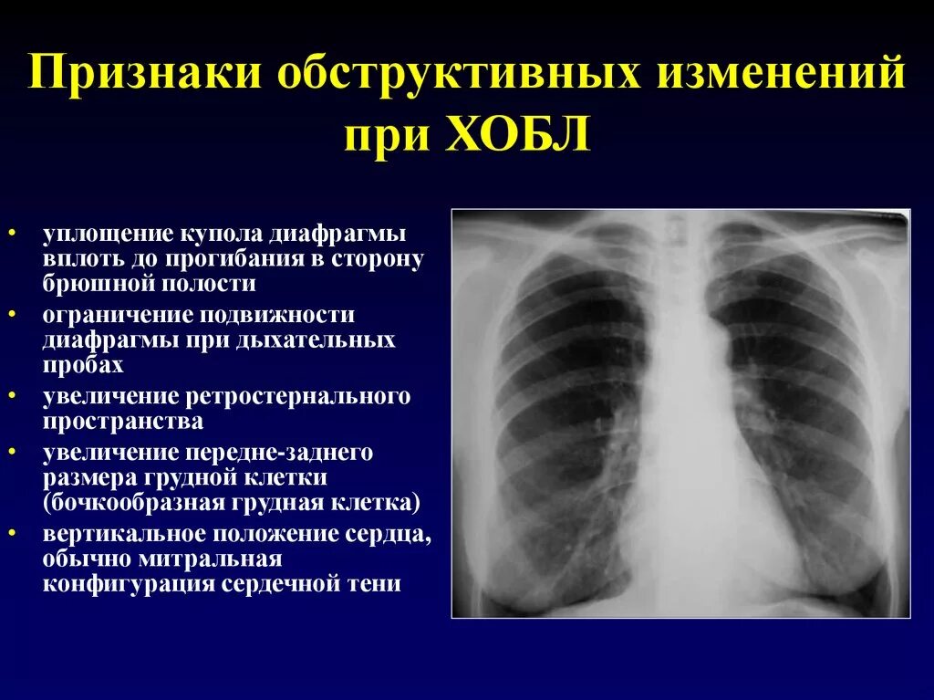 Острая болезнь легких