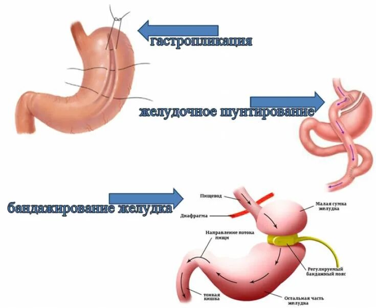 Умер от резекции желудка. Бариатрическая операция при ожирении. Бариатрическая операция шунтирование желудка. Бариатрия резекция желудка. Бариатрическая операция на желудке хирургия.