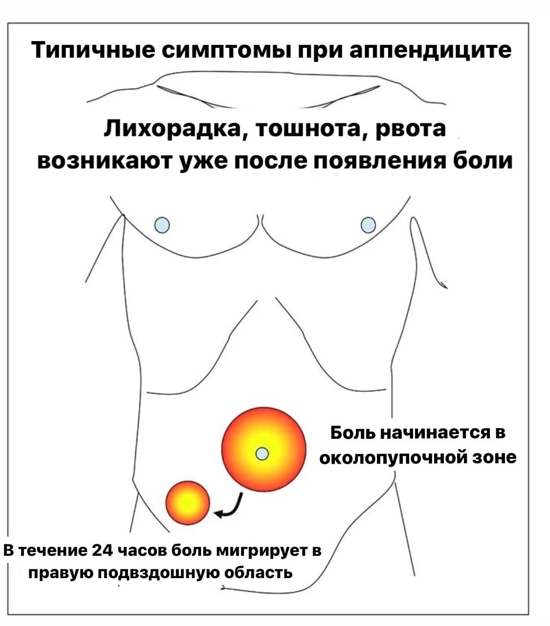 Типичные симптомы аппендицита. Симптомы при аппендиците. Воспаление аппендицита. Предпосылки аппендицита.