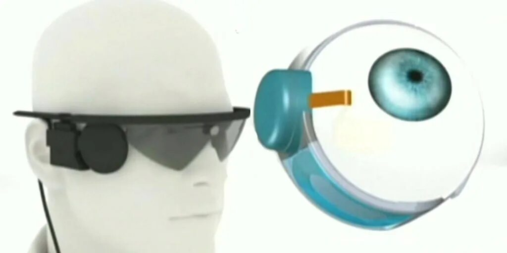 Argus ii. Argus ii протезы. бионический глаз argus ii. имплантат сетчатки argus ii. аргус 2 зрение.
