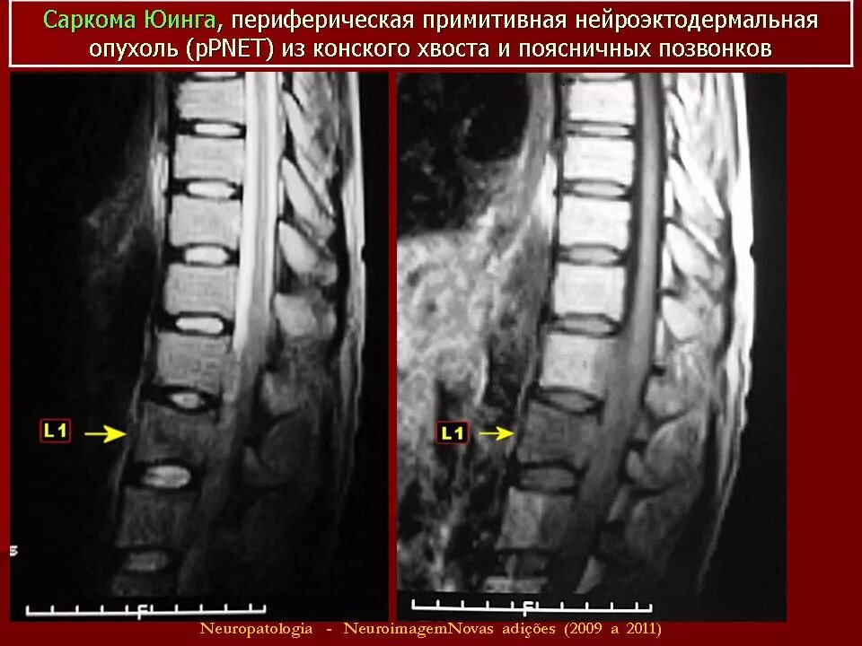 Рак поясницы. Саркома позвоночника на мрт. Остеогенная саркома позвоночника. Метастазы в позвоночнике на мрт.