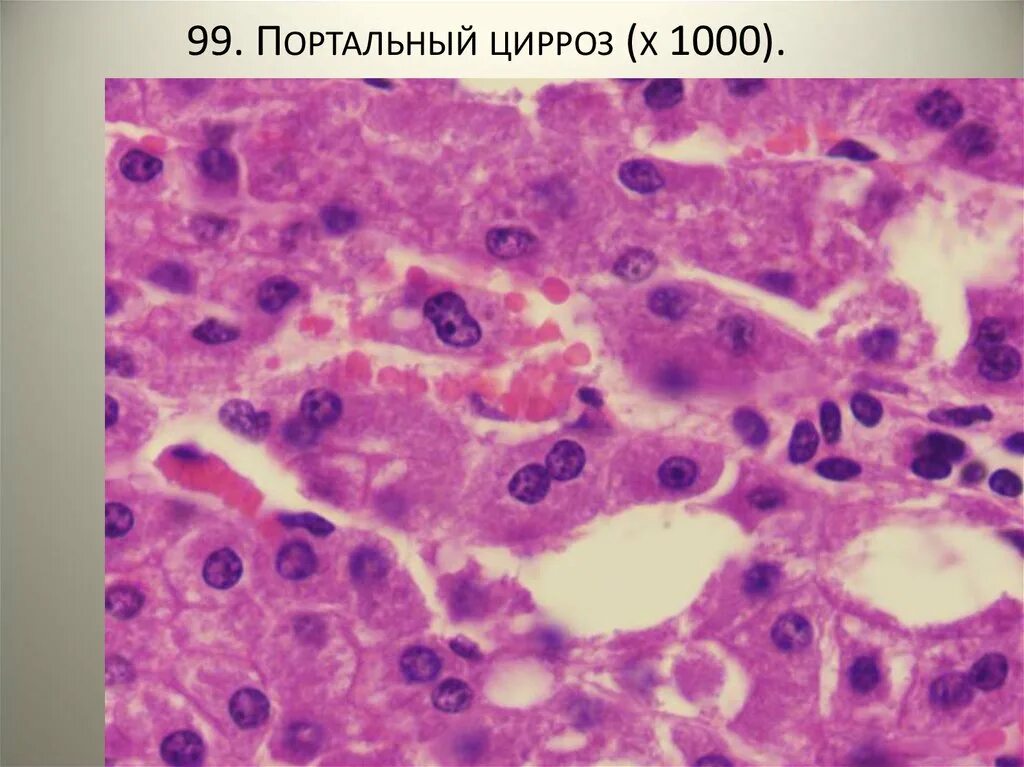 Печень портальный. Постнекротическийцирроз микропрепарат. постнекротический цирроз печени. портальный цирроз печени. портальный цирроз печени макропрепарат.