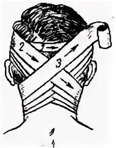 Техника наложения крестообразной повязки. Восьмиобразная повязка на затылок и шею. Крестообразная повязка алгоритм. Крестообразная повязка на затылок и шею. Крестообразная на затылок бинтовая повязка.