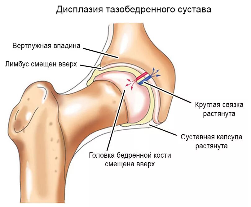 Растяжение связок сустава мкб. Дисплазия вертлужной впадины тазобедренного сустава. Лимбус тазобедренного сустава. Подвывих головка левой бедренной кости. Бурсит бедренной кости.