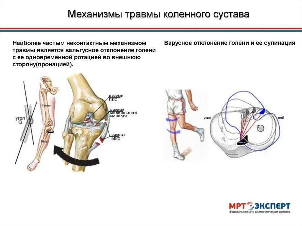 Повреждения коленного сустава травматология. Механизм повреждения коленного сустава. Механизм повреждения менисков. Механизм повреждения менисков коленного сустава.