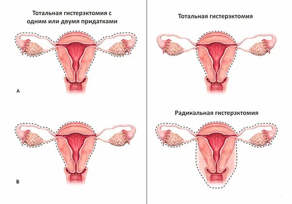 Гистерэктомия что это такое простыми. Субтотальная гистерэктомия. Тотальная гистеротомия. Тотальная гистерэктомия с придатками. Радикальная гистерэктомия.