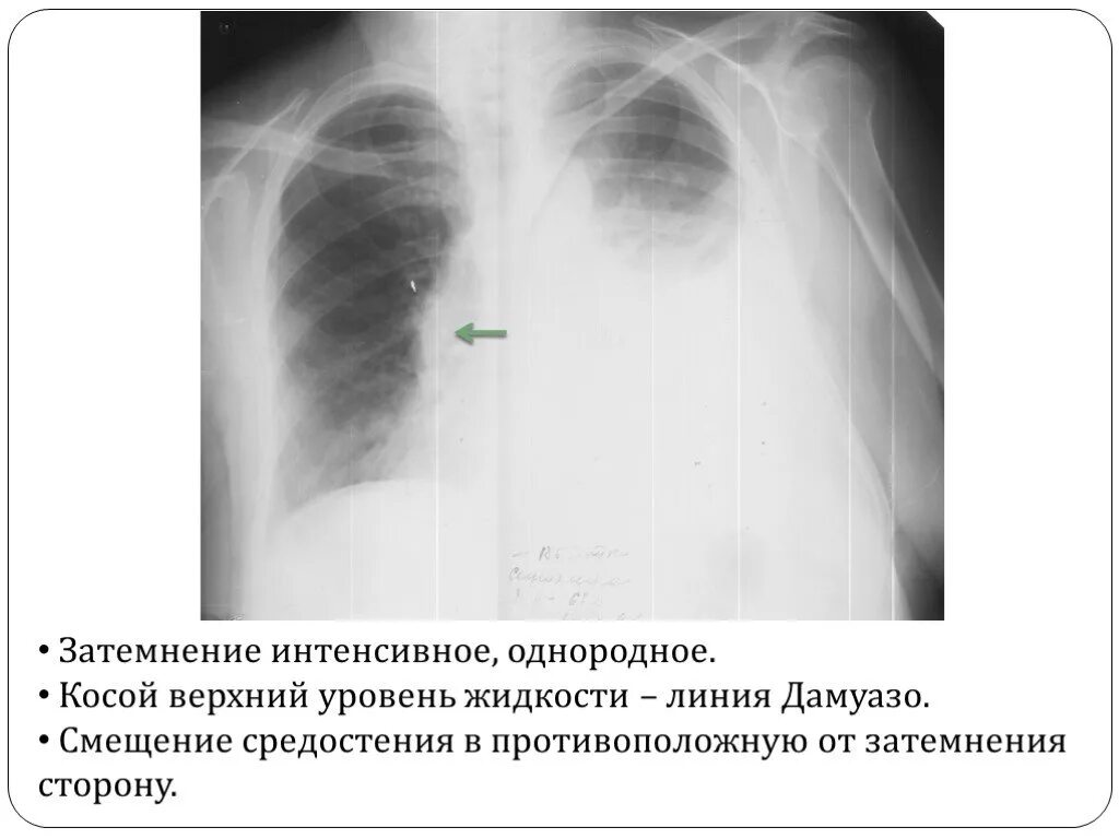 Уровень на рентгене. Линия эллиса дамуазо рентген. линия эллиса дамуазо соколова на рентгене. экссудативный плеврит рентген линия дамуазо. линия дамуазо на рентгене плеврит.