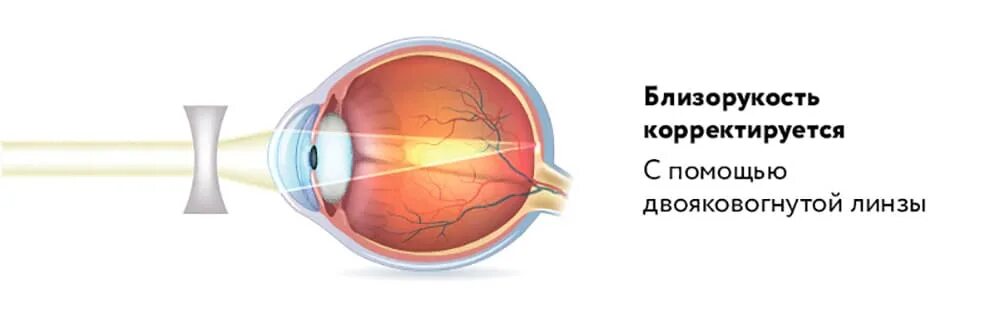 Близорукость. Близорукость картинки. Прогрессирование миопии. Зрение при близорукости.