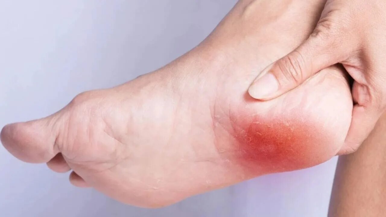 пяточная шпора и подошвенный фасциит. шпоры под ногой. пяточная шпора что это и как лечить. плантарный фиброматоз. шпоры под ногой.