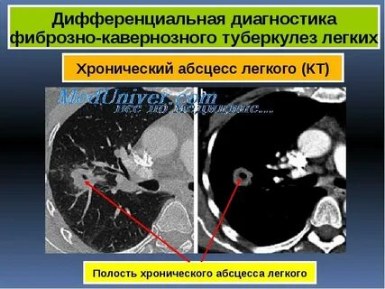 Кавернозный туберкулез кт