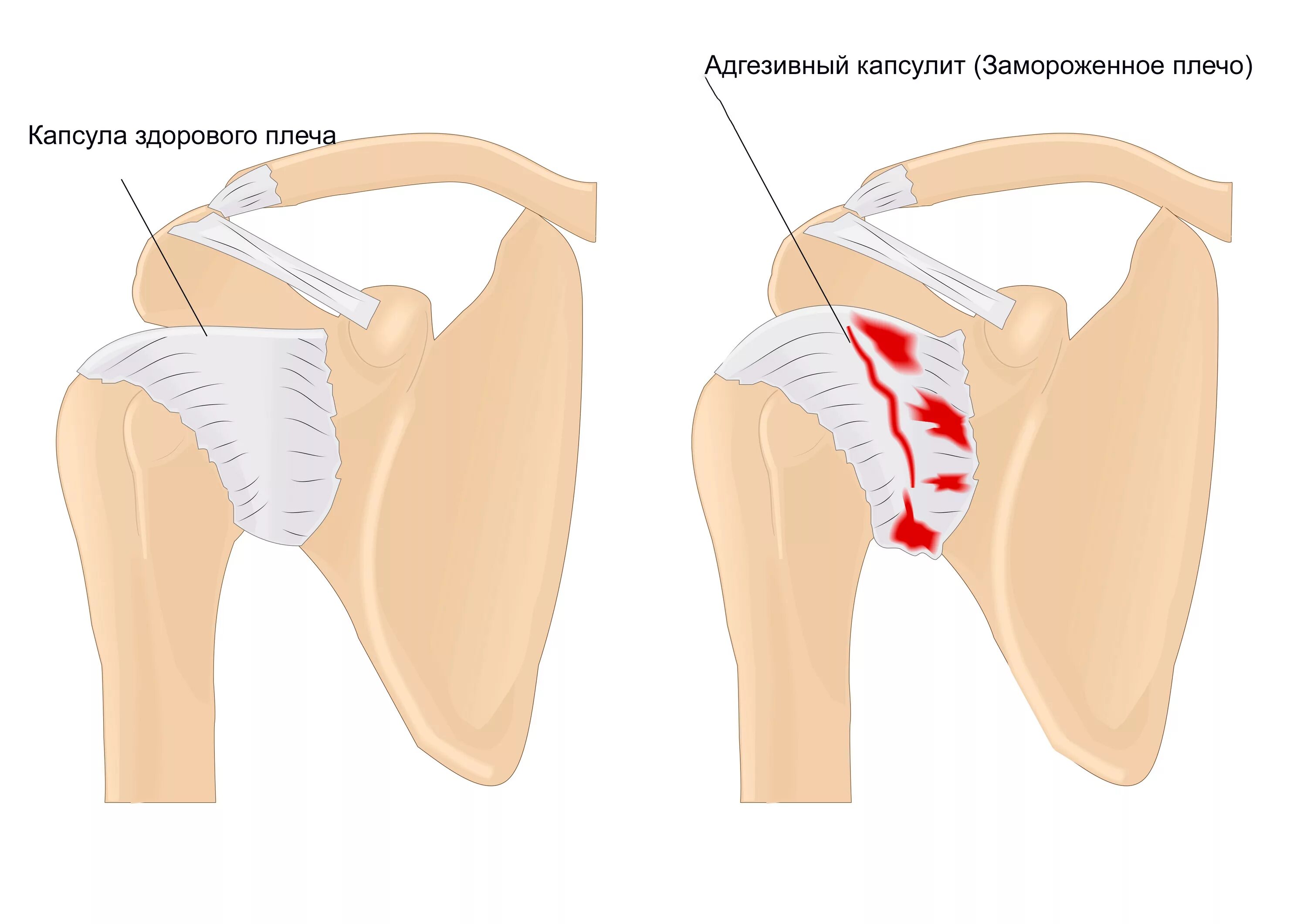 Адгезивный капсулит плеча рентген. Адгезивный капсулит плечевого сустава симптомы. Адгезивный капсулит плечевого сустава («замороженное плечо»). Адгезивный капсулит плечевого сустава рентген.