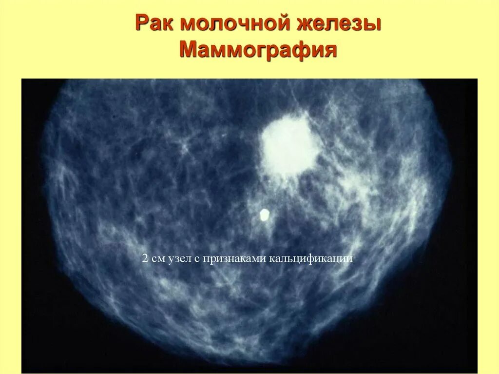 Рак молочной железы на маммографии