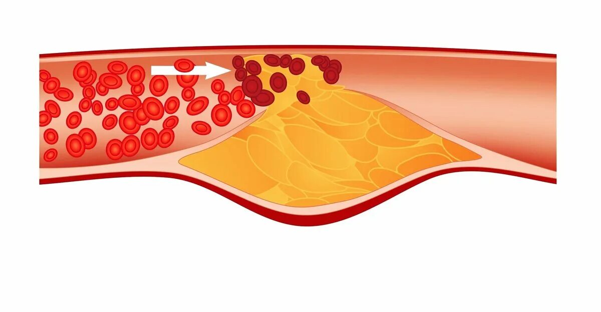 Отрыв атеросклеротической бляшки. Тромбоз атеросклеротической бляшки. Разрыв бляшки атеросклероз тромб. Разрыв атеросклеротической бляшки при инфаркте миокарда. Как проверить сосуды на тромбы и холестериновые