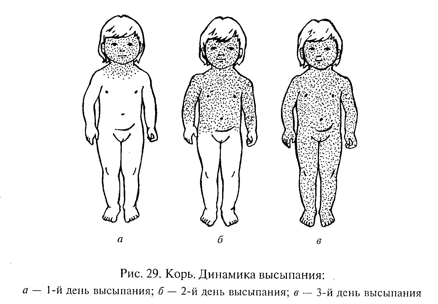 Корь этапность