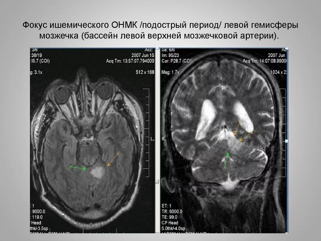 Инсульт в бассейне мозговой артерии. Ишемический инсульт мозжечка головного мозга кт. Инсульт мозжечка кт. Ишемический ОНМК мрт. Инфаркт мозжечка кт.