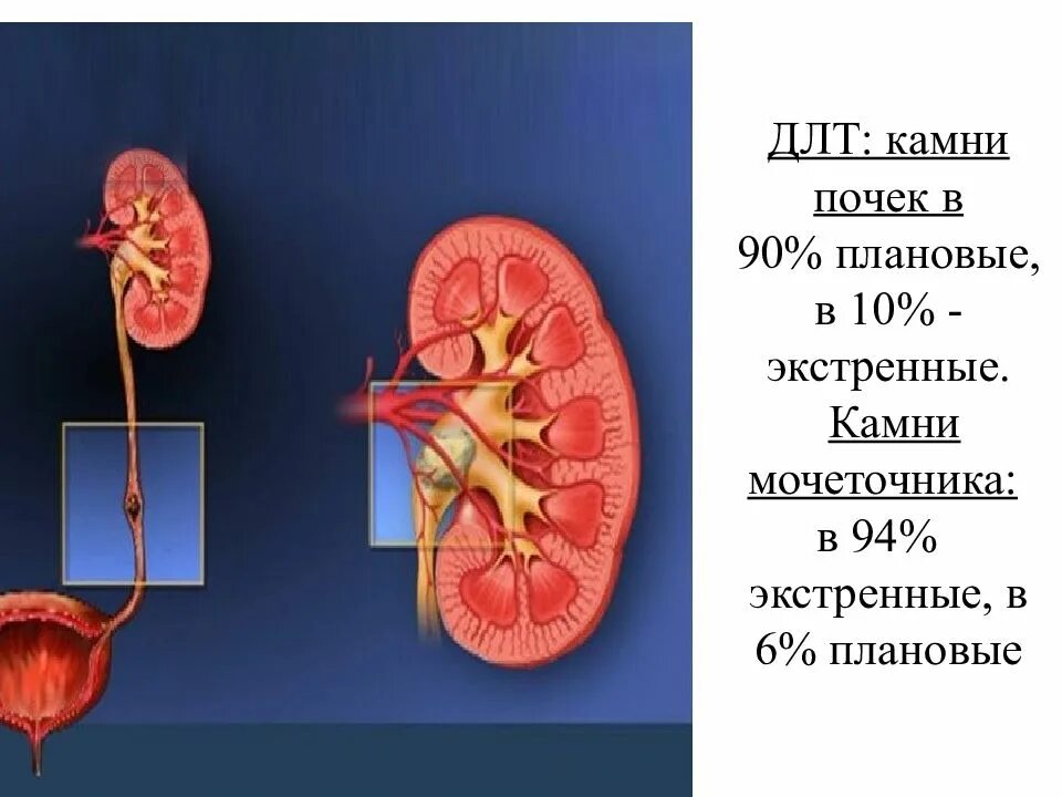 Камни в почках и мочеточнике. Дистанционная литотрипсия при камнях почек. Камни в почках (конкременты).