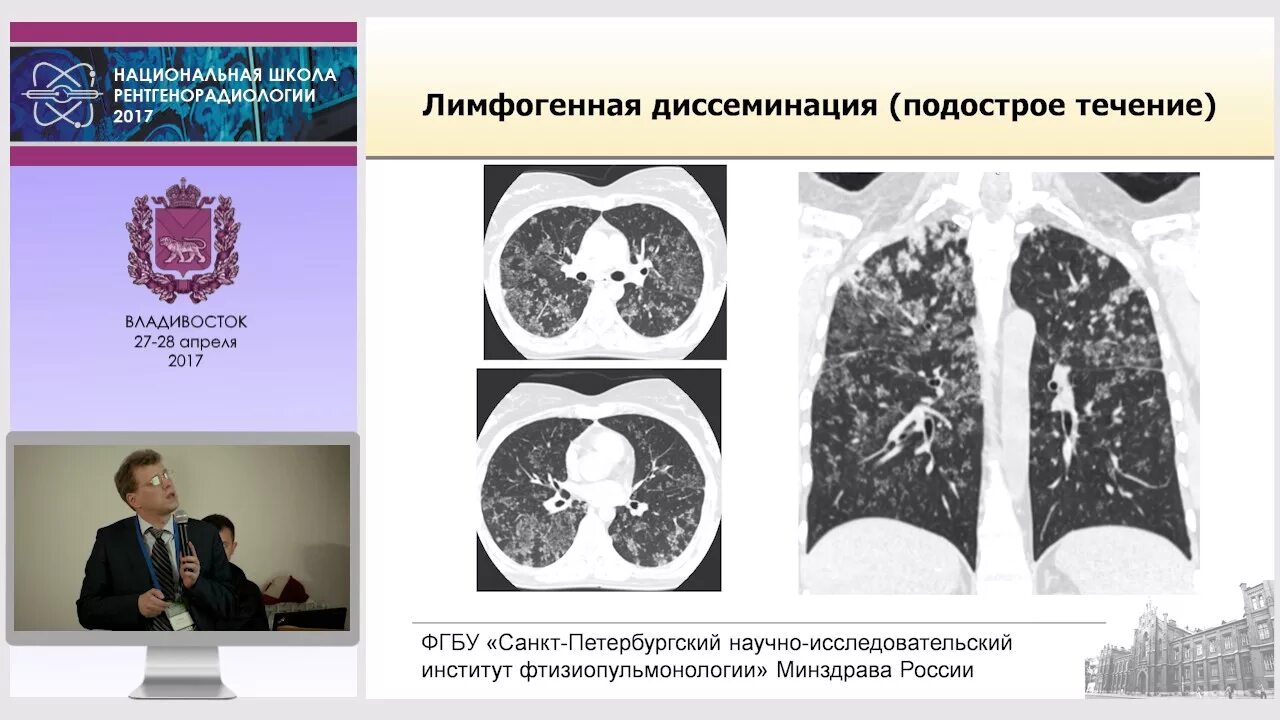 Лимфогенный туберкулез. Диссеминированный кавернозный туберкулез кт. Диссеминированный туберкулез на кт. Кт диссеминированного туберкулёза. Диссеминированный туберкулёз лёгких кт.