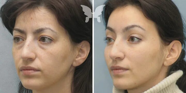 эндоскопическая подтяжка верхней трети лица. эндоскопическая подтяжка верхней трети лица. эндоскопическая подтяжка лица. эндоскопический лобно-височный лифтинг. эндолифтинг.