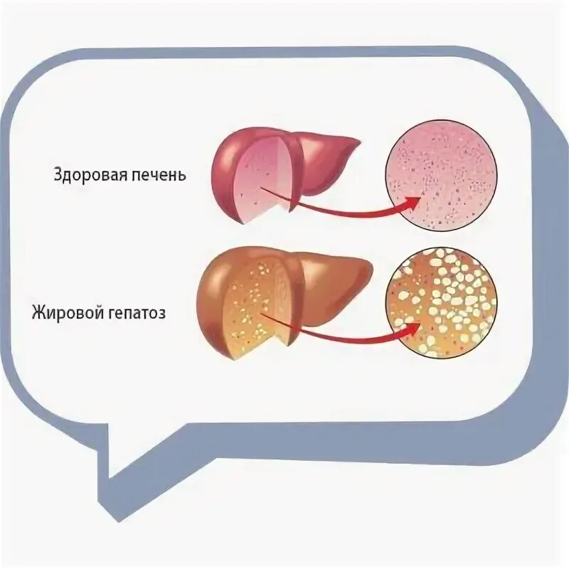 Картинки ЧТО ПИТЬ ПРИ ГЕПАТОЗЕ ПЕЧЕНИ
