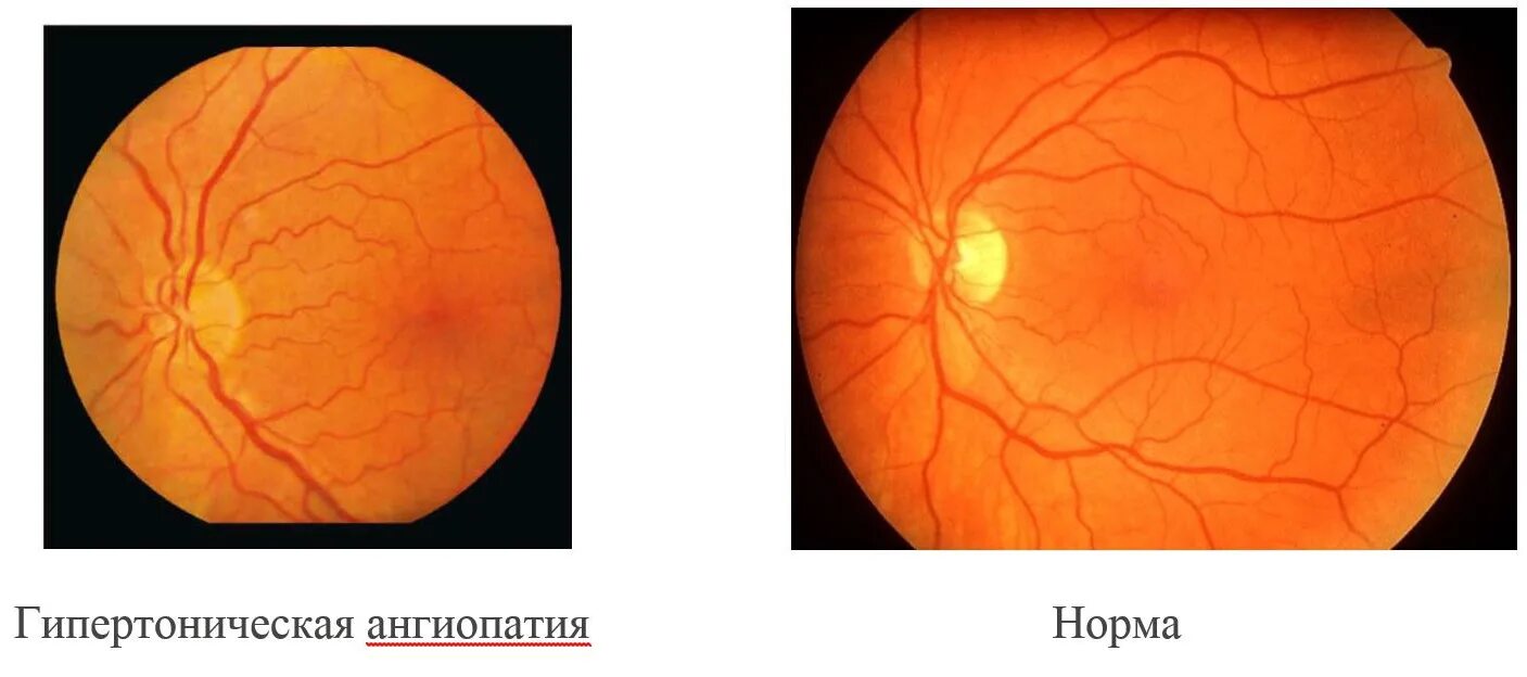 Изменение на глазном дне. Ангиопатия сетчатки глаза ou. Ангиопатия сосудов сетчатки. Гипертоническая ангиопатия сетчатки. Ангиопатия сетчатки глазное дно.