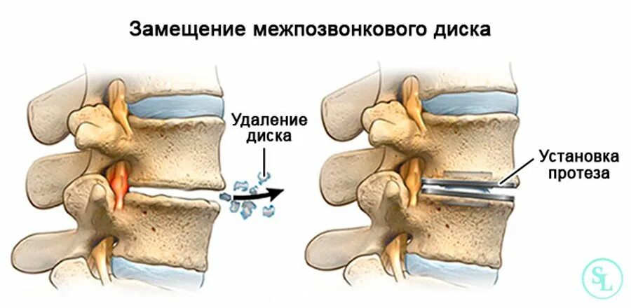 Операция по замене позвоночника. Межпозвоночный имплант поясничного отдела. Протез межпозвоночного диска. Протез диска позвоночника. Искусственный межпозвоночный диск.