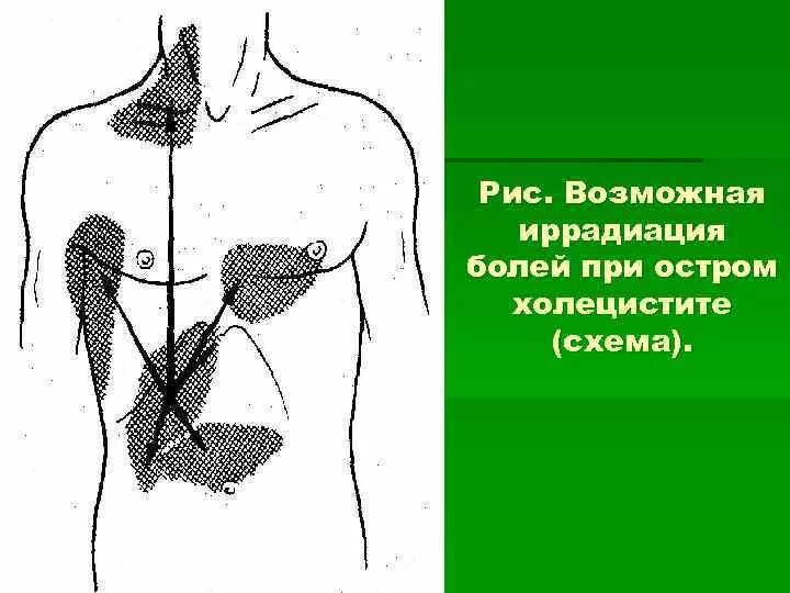 Холецистит иррадиация болей. Хронический холецистит иррадиация болей. Холецистит калькулезный иррадиация болей. Иррадиация при остром холецистите.