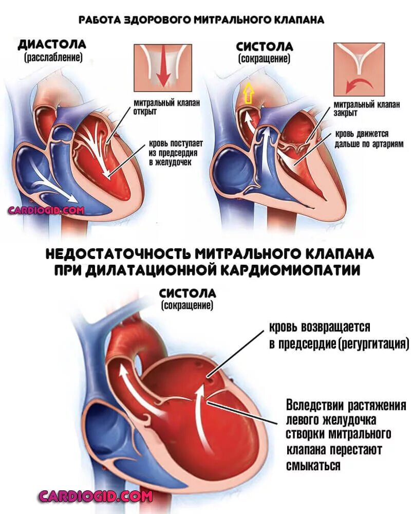 Сердечная недостаточность митрального клапана. Недостаточность двустворчатого (митрального) клапана. Недостаточность митрального клапана схема. Недостаточность створок митрального клапана. Приобретённый порк сердца стеноз митрального клапана.