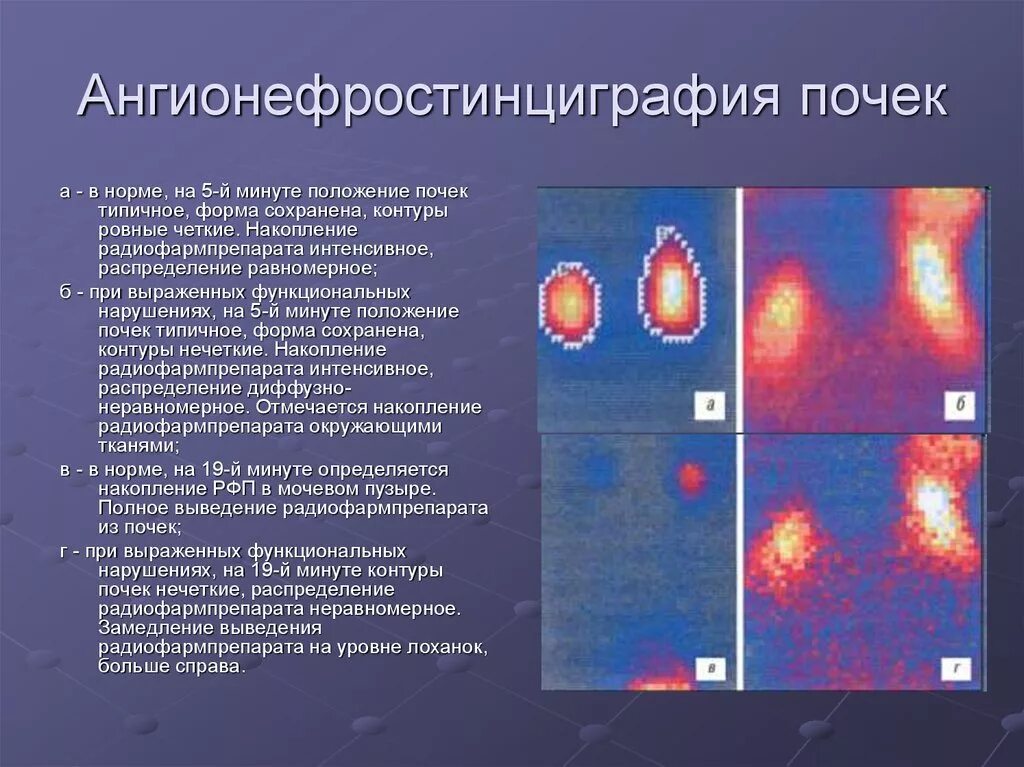 Сцинтиграфия почек. Динамическая сцинтиграфия. Динамическая сцинтиграфия почек. Статическая сцинтиграфия почек.