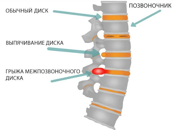 Симптомы межпозвоночной грыжи. Замена межпозвоночного диска. Гидронуклеопластика межпозвонковых дисков. Высота межпозвонковых дисков. Функции межпозвоночного диска.