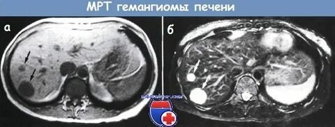 Болит печень гемангиома